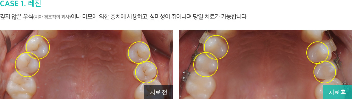 CASE 1. 레진 깊지 않은 우식(치아 경조직의 괴사)이나 마모에 의한 충치에 사용하고, 심미성이 뛰어나며 당일 치료가 가능합니다. 