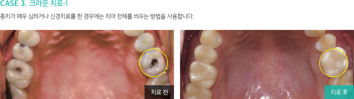CASE 3. 크라운 치료-1 충치가 매우 심하거나 신경치료를 한 경우에는 치아 전체를 씌우는 방법을 사용합니다.