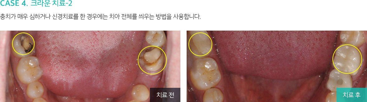 CASE 4. 크라운 치료-2 충치가 매우 심하거나 신경치료를 한 경우에는 치아 전체를 씌우는 방법을 사용합니다.